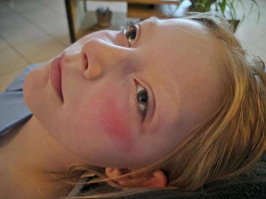jeune demoiselle avec des brûlures sur les joues dû à une crème.